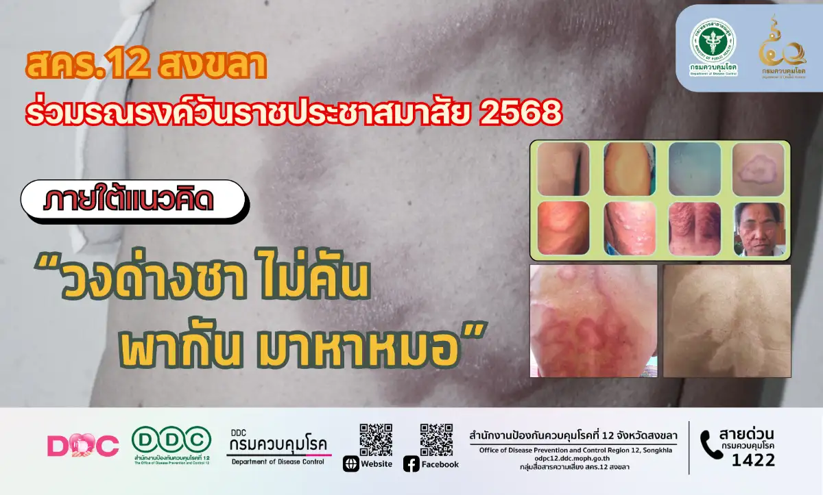 สคร.12 สงขลา ร่วมรณรงค์วันราชประชาสมาสัย 2568  ภายใต้แนวคิด “วงด่างชา ไม่คัน พากัน มาหาหมอ”